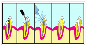 Baby Nerve Treatment 031