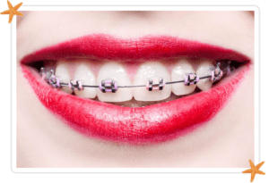 traditional braces